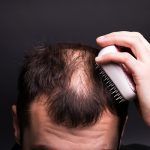 Alopecia androgenética